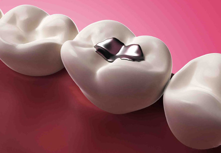 Amalgam Filling