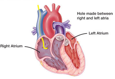 Atrial Septostomy