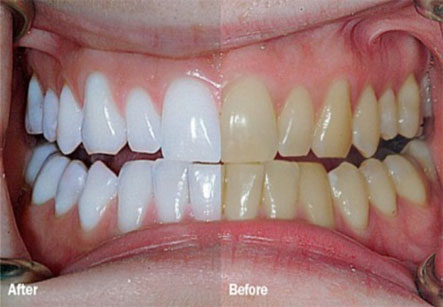 Chemical Teeth Whitening