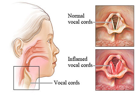 Direct Laryngoscopy