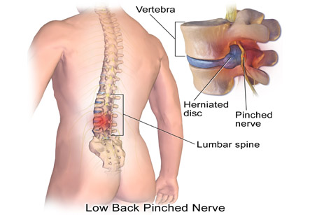 Herniated Disc