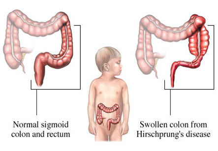 Hirschsprung Disease