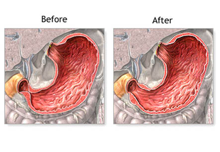 Hypertrophic Pyloric Stenosis