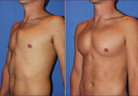 Male Breast Implants