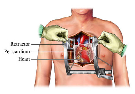 Open Heart Surgery