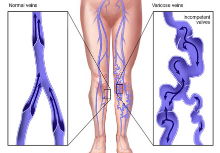 Sclerotherapy