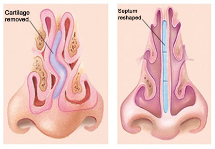 Septoplasty